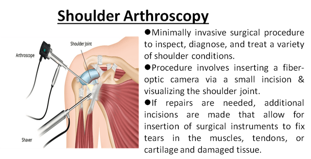 shoulder arthroscopy