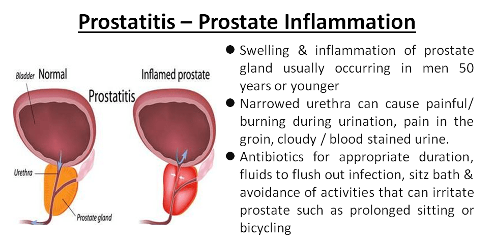 Meddig kezelik a fertőző prostatitist?, A fertőzések által okozott prostatitis