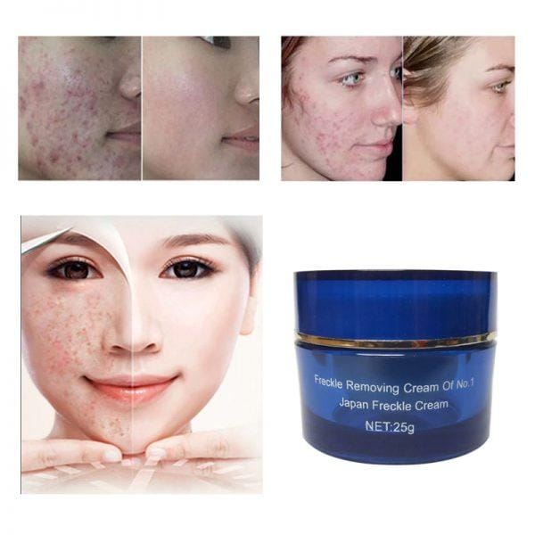 anti freckle cream