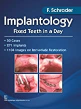 Implantology Fixed Teeth In A Day (Pb 2017)  By Schrader