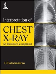 Interpretation Of Chest X-Ray An Illustrated Companion 1st Edition By Balachandran G