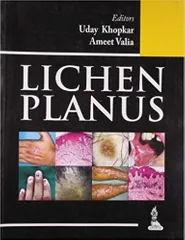 Lichen Planus 1st Edition 2013 By Uday Khopkar
